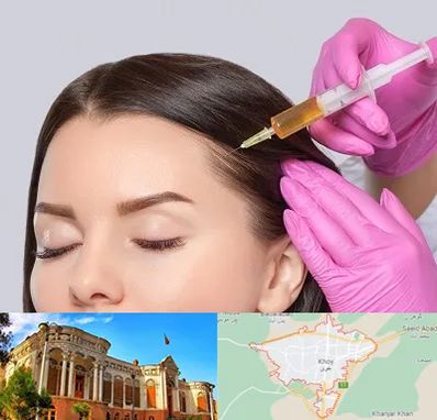 تزریق هیر فیلر در خوی