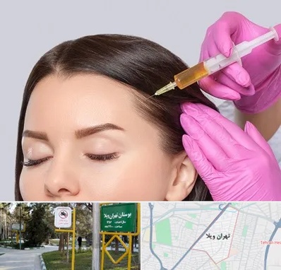 تزریق هیر فیلر در تهران ویلا