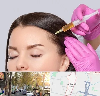 تزریق هیر فیلر در کاشانک