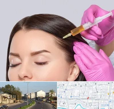 تزریق هیر فیلر در ضیابری رشت