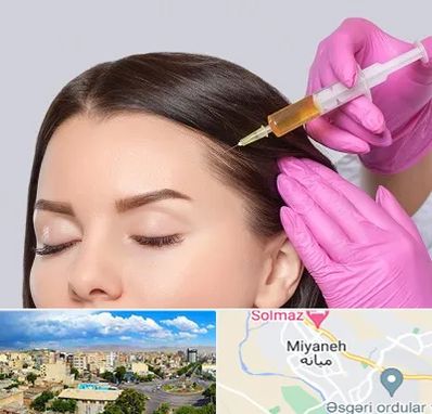 تزریق هیر فیلر در میانه