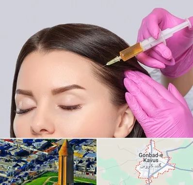تزریق هیر فیلر در گنبد کاووس