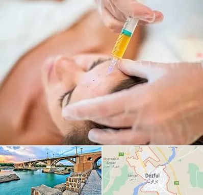 پی آر پی در دزفول