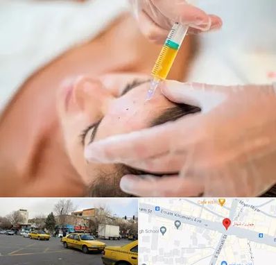 پی آر پی در شهناز تبریز