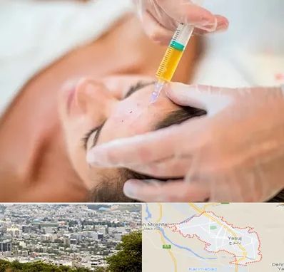 پی آر پی در یاسوج