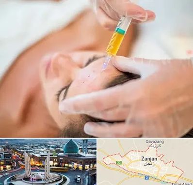 پی آر پی در زنجان