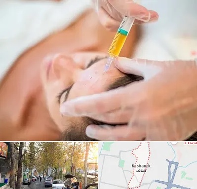 پی آر پی در کاشانک