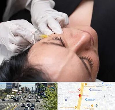 کربوکسی تراپی در ستاری 