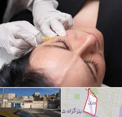 کربوکسی تراپی در اتابک