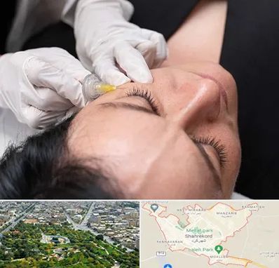 کربوکسی تراپی در شهرکرد