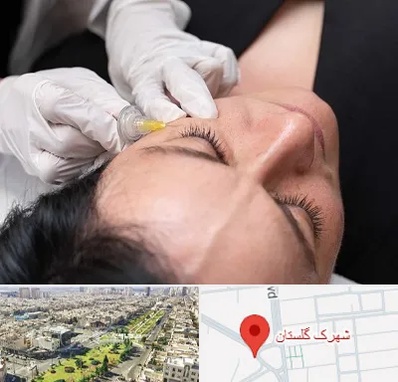 کربوکسی تراپی در شهرک گلستان