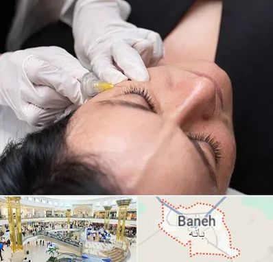کربوکسی تراپی در بانه