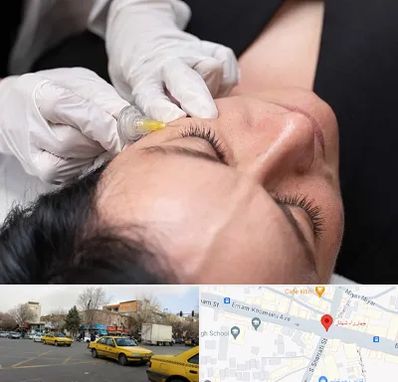 کربوکسی تراپی در شهناز تبریز