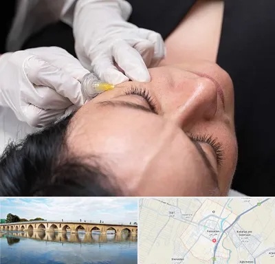 کربوکسی تراپی در فلاورجان