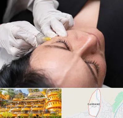 کربوکسی تراپی در دربند