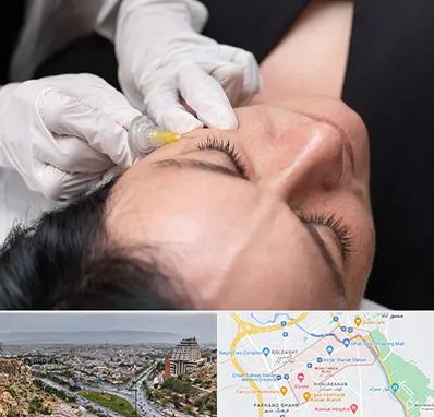 کربوکسی تراپی در معالی آباد شیراز