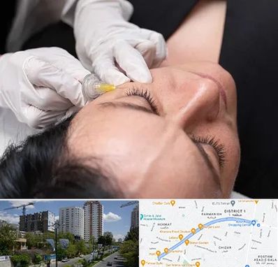 کربوکسی تراپی در اندرزگو