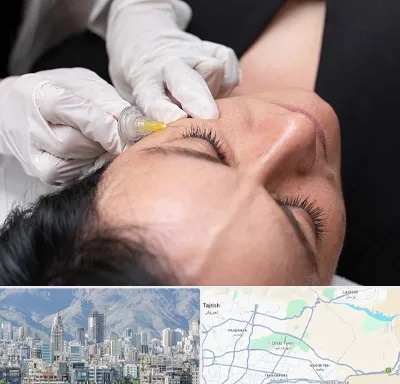 کربوکسی تراپی در شمال شرق تهران