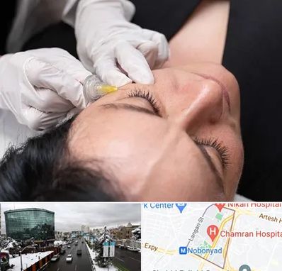 کربوکسی تراپی در اقدسیه 