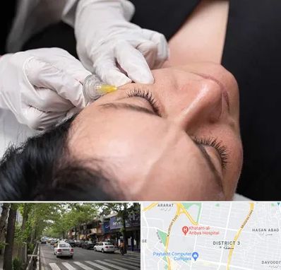 کربوکسی تراپی در ظفر 