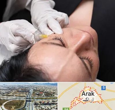 کربوکسی تراپی در اراک