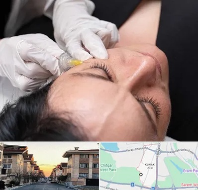 کربوکسی تراپی در کوهک