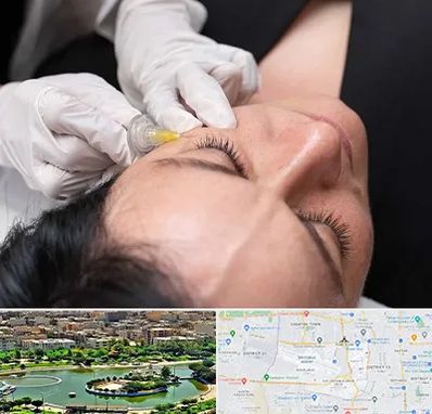 کربوکسی تراپی در منطقه 9 تهران 