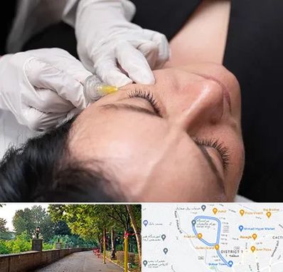 کربوکسی تراپی در فلکه گاز رشت