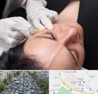 کربوکسی تراپی در گلشهر کرج