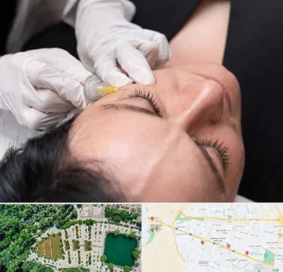 کربوکسی تراپی در وکیل آباد مشهد