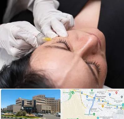 کربوکسی تراپی در صیاد شیرازی مشهد