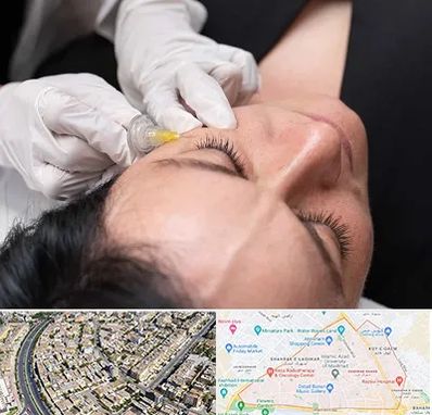 کربوکسی تراپی در شهرک غرب مشهد