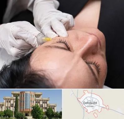 کربوکسی تراپی در دهدشت