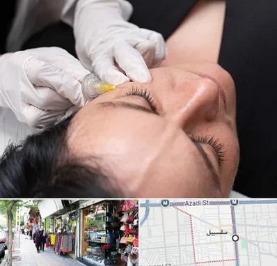 کربوکسی تراپی در سلسبیل