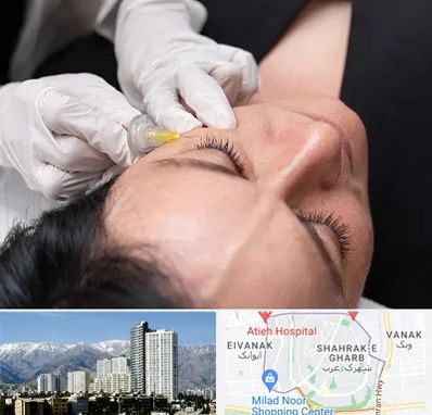 کربوکسی تراپی در شهرک غرب 