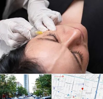 کربوکسی تراپی در امامت مشهد