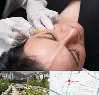 کربوکسی تراپی در بلوار تعاون