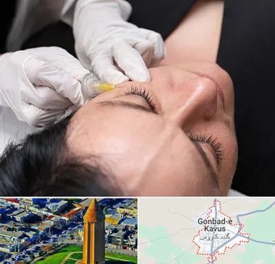 کربوکسی تراپی در گنبد کاووس
