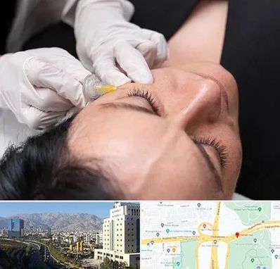 کربوکسی تراپی در حقانی 