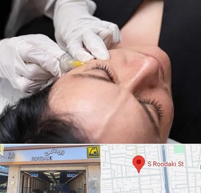 کربوکسی تراپی در رودکی