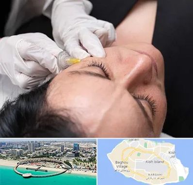 کربوکسی تراپی در کیش