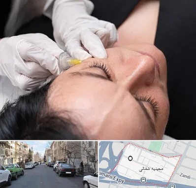 کربوکسی تراپی در مجیدیه شمالی