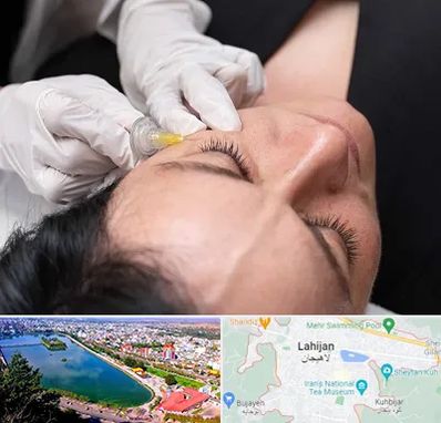 کربوکسی تراپی در لاهیجان