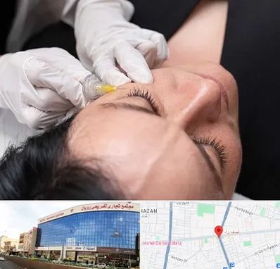 کربوکسی تراپی در نصف راه تبریز