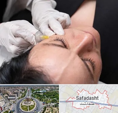 کربوکسی تراپی در صفادشت