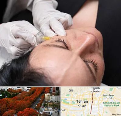 کربوکسی تراپی در ولیعصر 