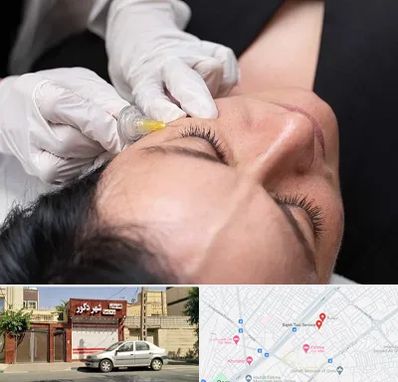 کربوکسی تراپی در باجک قم