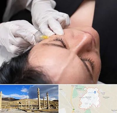 کربوکسی تراپی در مرودشت