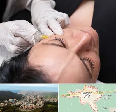 کربوکسی تراپی در گرگان