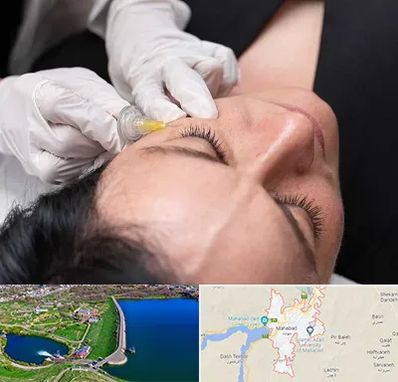 کربوکسی تراپی در مهاباد